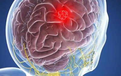 Waspadai Meningioma: Tumor Jinak dalam Otak